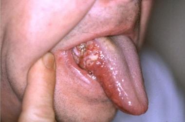Scientists discover biomarker for tongue cancer 