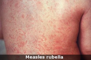 Measles rubella vaccine campaign added to flagship Universal Immunisation Programme