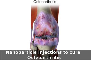 Nanoparticle injections to cure Osteoarthritis!