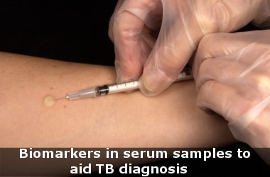 Biomarkers in serum samples to aid TB diagnosis