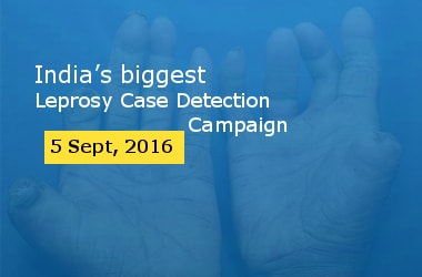 India’s biggest leprosy eradication programme launched 